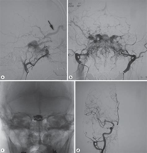 Figure From Intercavernous Sinus Dural Arteriovenous Fistula Treated