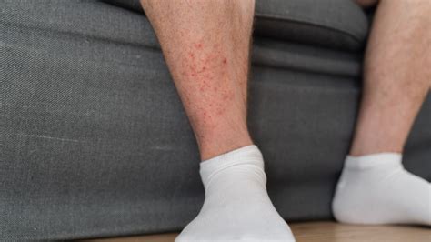 What is hiker's rash? And is it serious? | Advnture