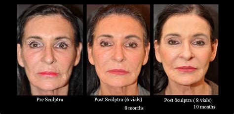 Sculptra Before And After Photo Gallery Dr Dean Kane