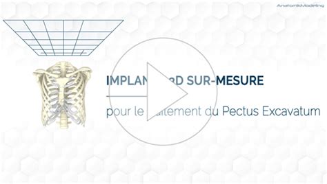 Traitement Du Pectus Excavatum Avec Implant 3d Sur Mesure