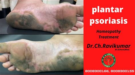 Best Plantar Psoriasis Treatment In Homeopathy Dr Ch Ravikumar M D