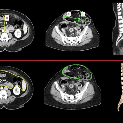 An Example Of D Measurement And D Volume Rendering Above D Ct