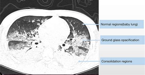 The Chest Ct Scan Of A 19 Year Old Male Diagnosed With Fulminant