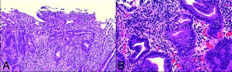 Biopsy Slides A Duodenal Villi Are Blunted And Minimally Congested