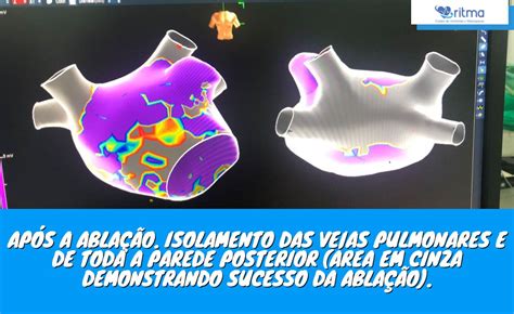 Ablação De Fibrilação Atrial Arritmia Em Uberlândia E Marcapasso