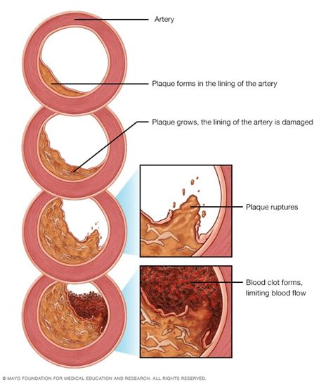 Development Of Atherosclerosis Mayo Clinic