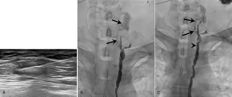 Granulomatous Lymphadenitis Mimicking Metastatic Lymphadenop Medicine