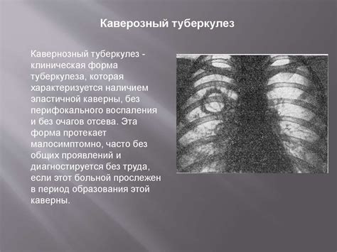 Туберкулез. Возбудитель туберкулеза - презентация онлайн