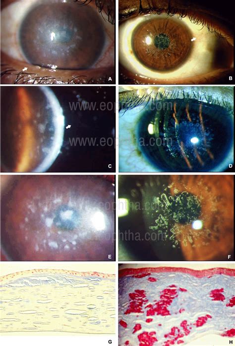 Corneal Dystrophy: A Ready Reckoner for Postgraduates