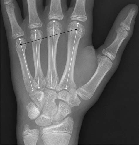 Dorsopalmar Left Hand Radiograph In A Year Old Boy Following Trauma