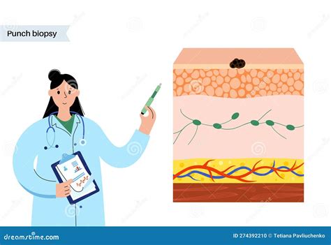 Punch biopsy procedure stock vector. Illustration of growth - 274392210