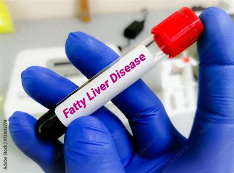 Blood sample for Fatty liver disease test. Liver enzyme test, LFT ...