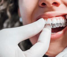 Maior Refer Ncia Em Invisalign Em Santo Andr Alinhadores