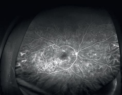 The Ultra Wide Field Fluorescein Angiography Uwffa Images Of Diabetic