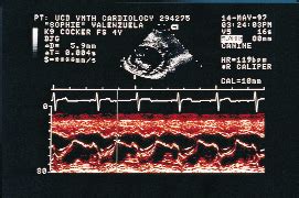 M Mode Short Axis Echocardiograms Of The Left Ventricle At The Mitral