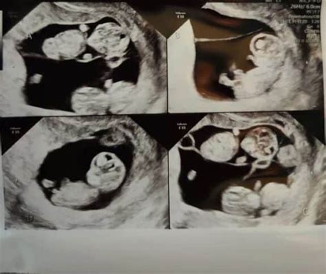 Jonathan and Mercedes Sandhus identical quadruplets ultrasound ...