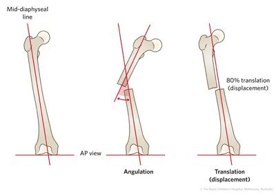 Fracture Education : Evaluation