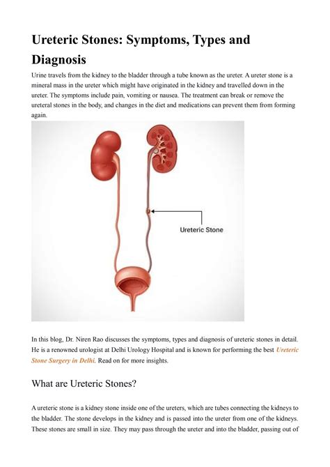 Ureteric Stones: Symptoms, Types and Diagnosis by delhiurologyhospital1 ...