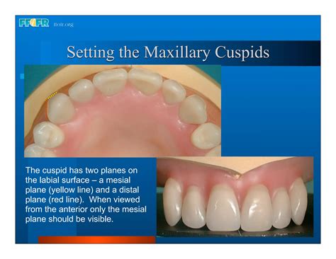 Complete Dentures 16occlusal Schemes Lingualized Occlusion Ppt