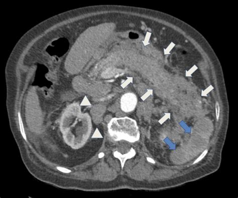 Cect Image On Arterial Phase Demonstrates A Diffusely Enlarged Pancreas