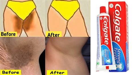 In Just Minutes Whitening Dark Underarm Challenge Underarms Whitening