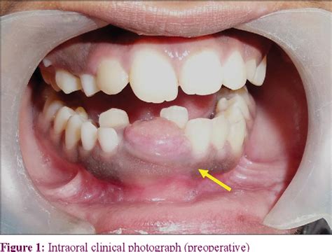 Figure 1 From An Unusual Presentation Of Adenomatoid Odontogenic Tumor