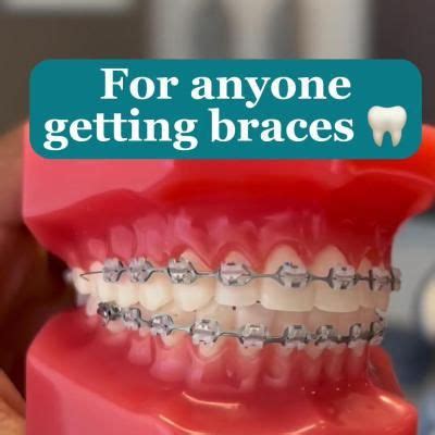 Preparing for Braces: 3 Essential Steps!