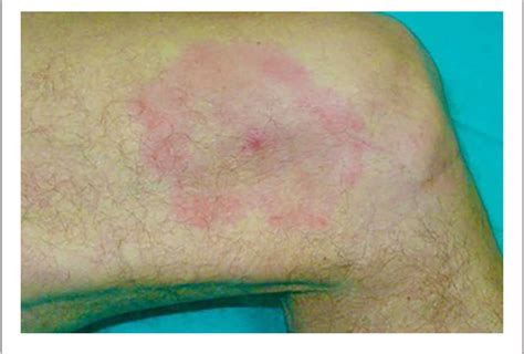 Figure 1 From A Practical Approach To The Diagnosis Of Lyme Borreliosis