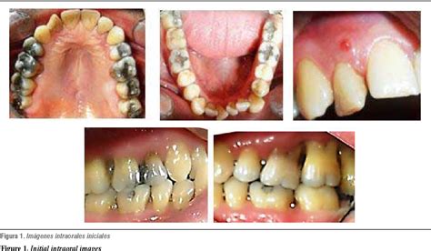 Figure From Tratamiento Cl Nico De Un Paciente Con Periodontitis