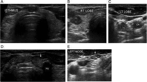 Isthmus Thyroid Ultrasound