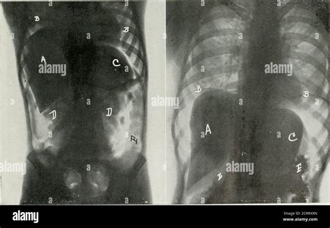 The American Journal Of Roentgenology Radium Therapy And Nuclear