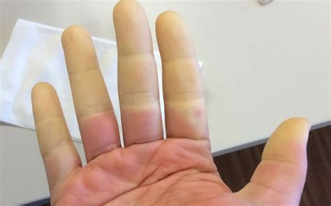 Raynaud Syndrom Fuß Wintertouren Fur Verfrorene Frauen Machbar Outdoorseiten Net