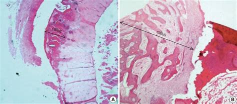 Callus formation as seen on the bone grafts Varying extents of callus ...