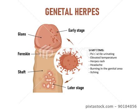 Genital herpes. Herpes simplex virus - Stock Illustration [90184856