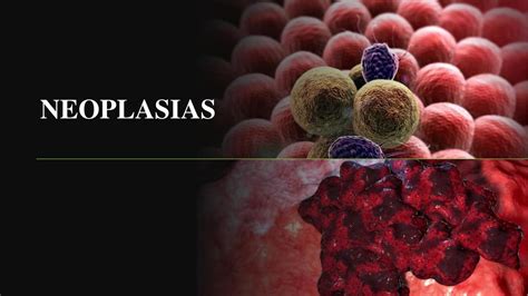 NEOPLASIAS Cáncer Célula Tumor uDocz