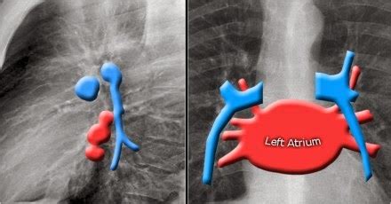 Chest Medicine Made Easy Dr Deepu Basics Of Chest X Ray Part The