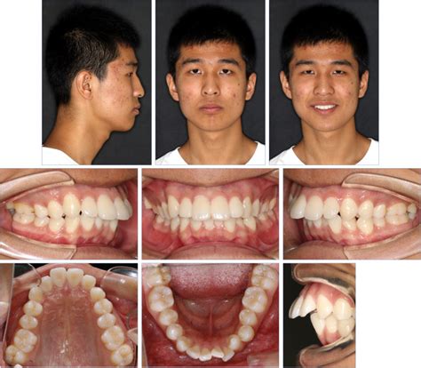 Maxillary Dentition Sequential Distalization Using Clear Aligners And Mini Implants In An Adult