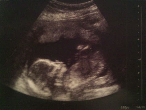 Tuesdays With Evan: Baby's Ultrasound at 17 weeks!