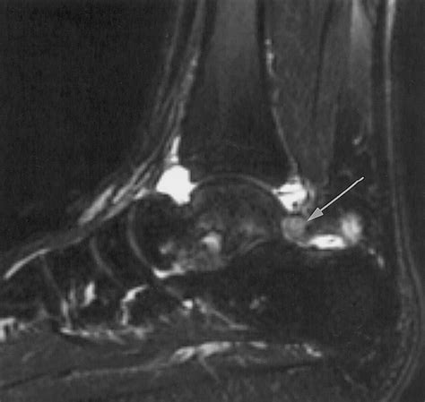 Soft Tissue And Osseous Impingement Syndromes Of The Ankle Role Of