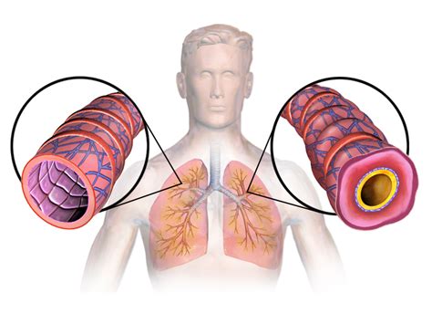 Lazitromicina Nel Trattamento Dellasma Bronchiale Newence