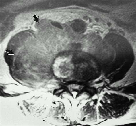 CT Of Unusual Iliopsoas Compartment Lesions RadioGraphics