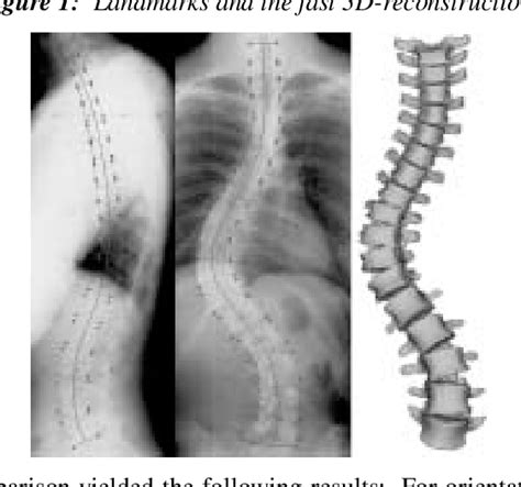 Figure From Fast Stereo Radiographic D Reconstruction Of The Spine