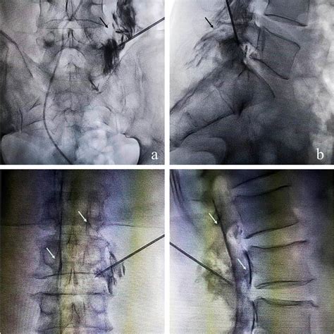 Anteroposterior And Lateral Intraoperative Fluoroscopic Images After