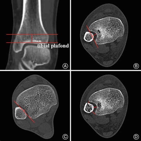 Measurement of fibular notch (FN)-related morphological parameters. (A ...