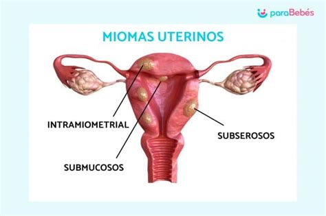 Cómo Disminuir Los Miomas En El Embarazo Mibbmemima ️