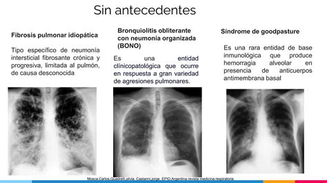 Enfermedad Pulmonar Intersticial Pptx