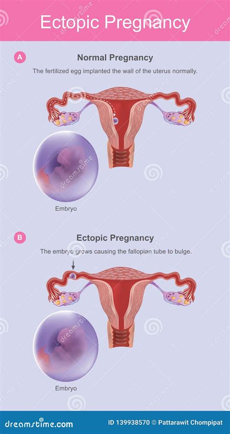 Symptoms Of Ectopic Pregnancy Infographics Illustration On Isolated