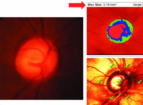 3 Physiological cupping of optic disc in glaucoma. | Download ...