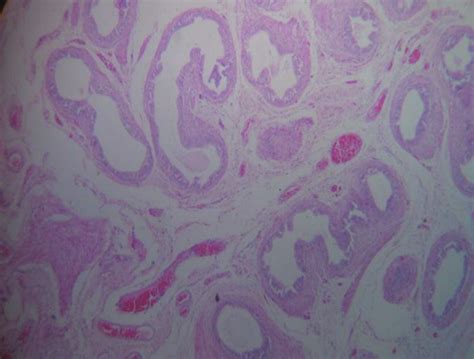 Histopathological Examination Hpe Of Resected Gonads Showing Atrophic