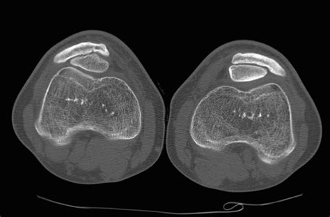 Bilateral Double Layered Patella Dlp With Supra Patellar Impingement